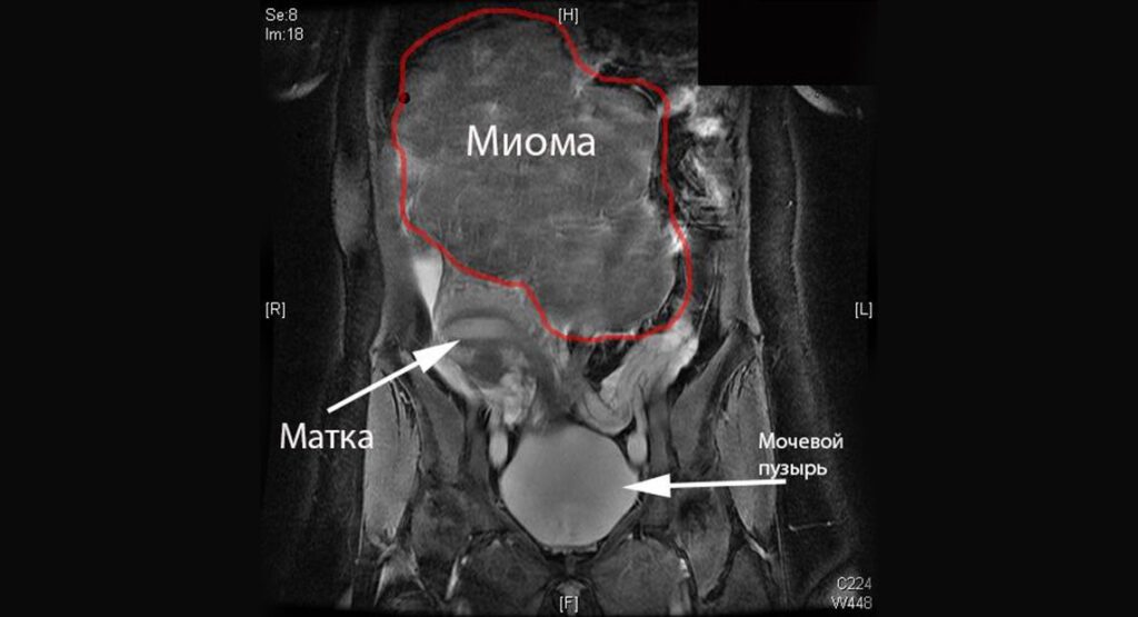 Миома матки